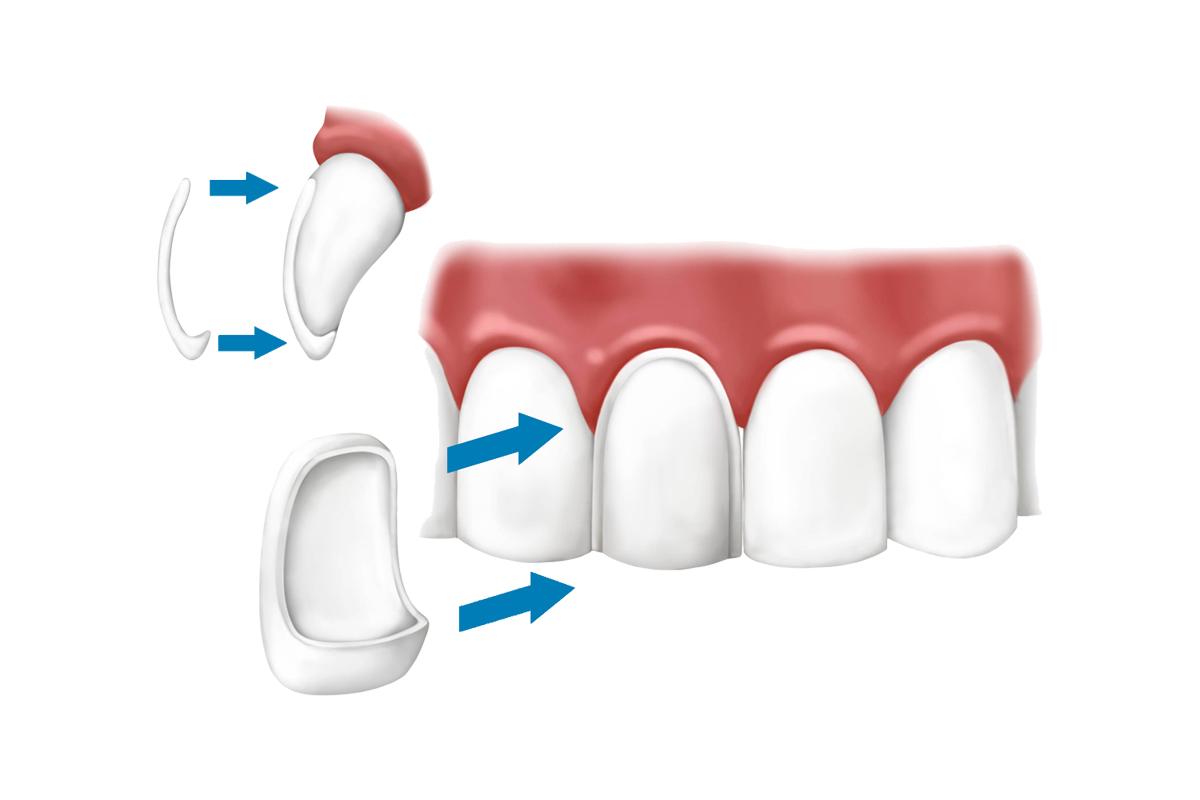 porcelain-veneer-teeth-bloomingdale-il_0.jpg